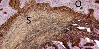 osteosarcoma-con-lettere